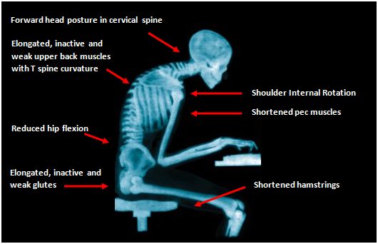 x-ray-of-bad-posture